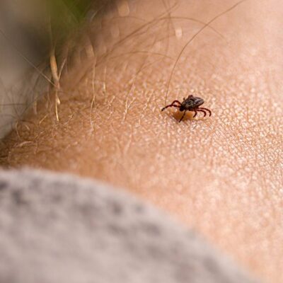 jak wyciągnąć kleszcza